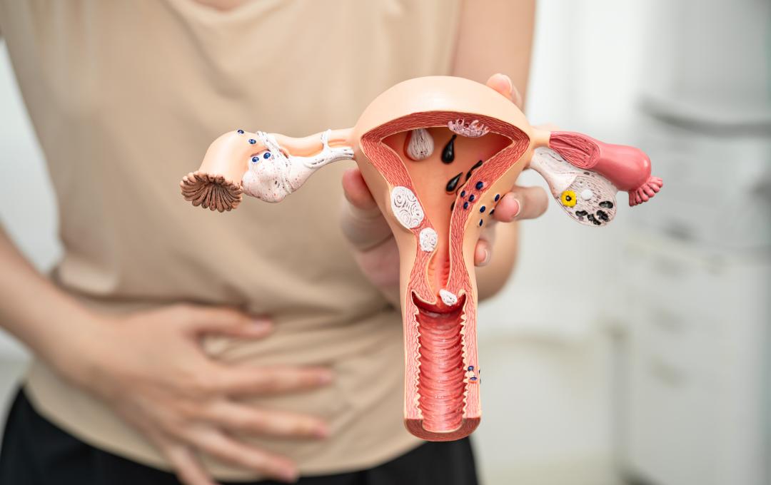 What Happens To Fibroids After Embolization? 2 Uterine fibroids before UFE