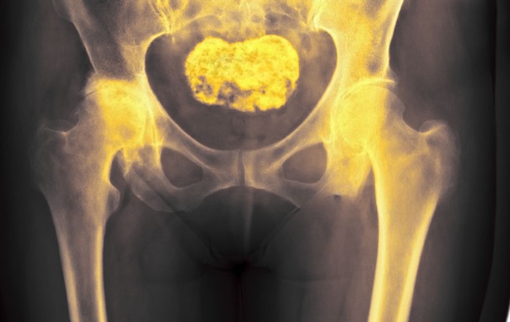 Calcified Fibroid 1 imaging showing a calcified fibroids