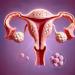 what is considered a large fibroid - blog (1)