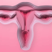 What Is Considered A Large Fibroid