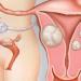 Different Size Uterine Fibroids