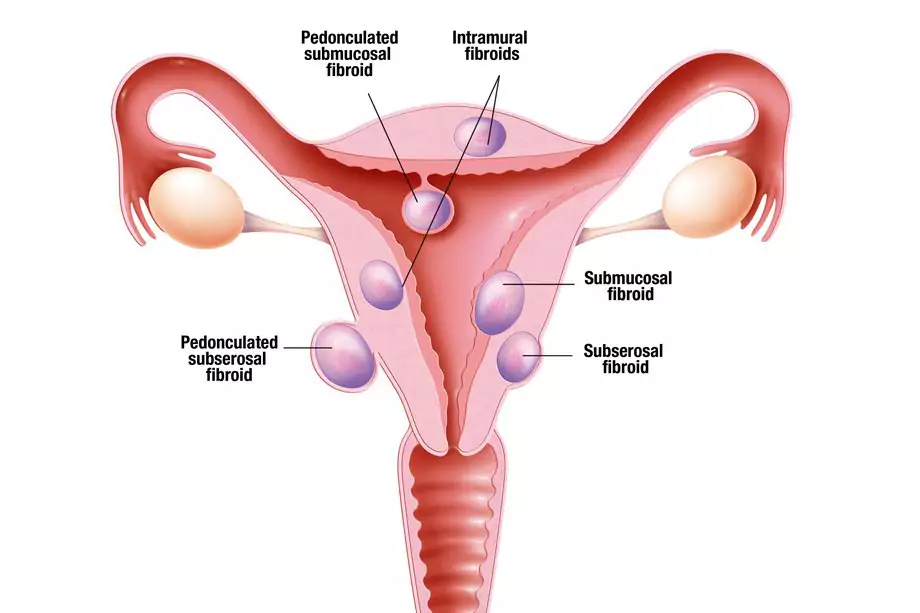 Multiple Fibroids Vs. A Single Fibroid: Does The Number Matter? 2 types-of-fibroids-diagram.jpg