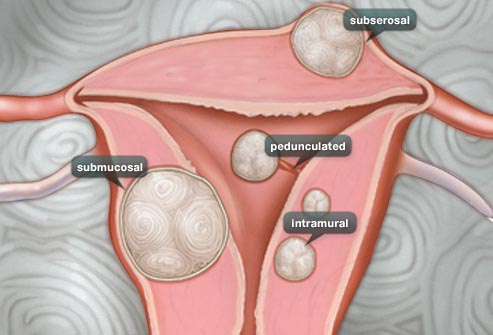 Can Fibroids Cause Miscarriages? 2 Types of Fibroids