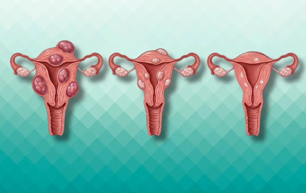 can glutathione shrink fibroid What Shrinks Fibroids Fast? كريم مضاد للخطوط الدقيقة