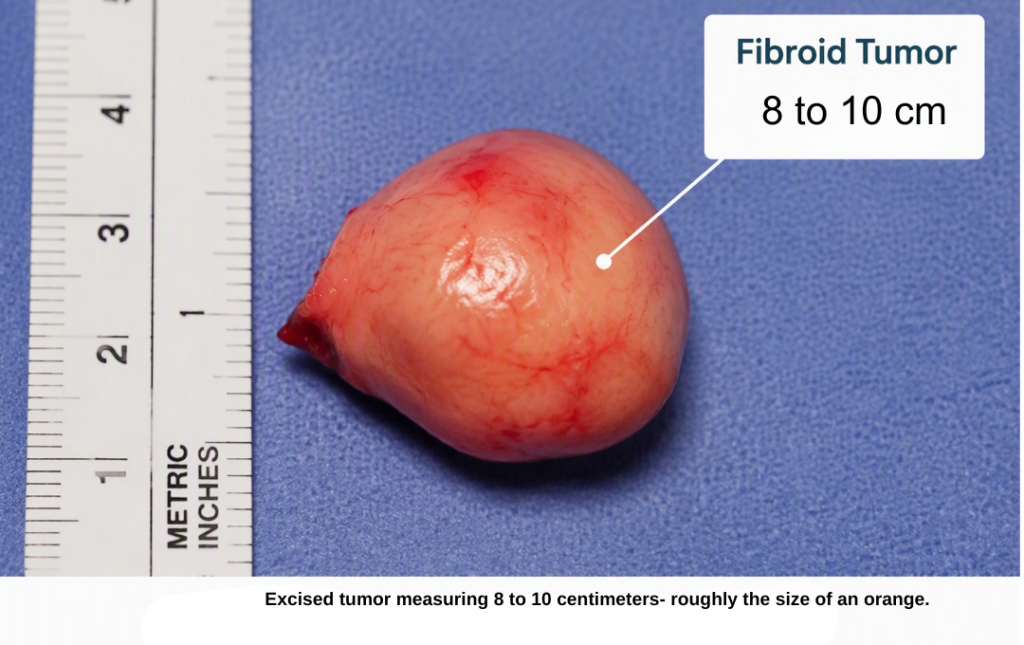 Multiple Fibroids Vs. A Single Fibroid: Does The Number Matter? 3 Image of encised fibroid about 8 cm
